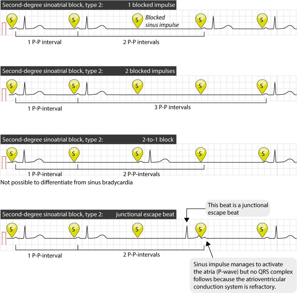 Sinus node dysfunction (SND) and sick sinus syndrome (SSS)