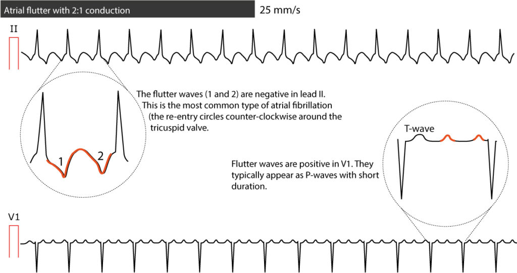 Vorhofflattern Einstufung Ursachen Ekg Kriterien Und Management