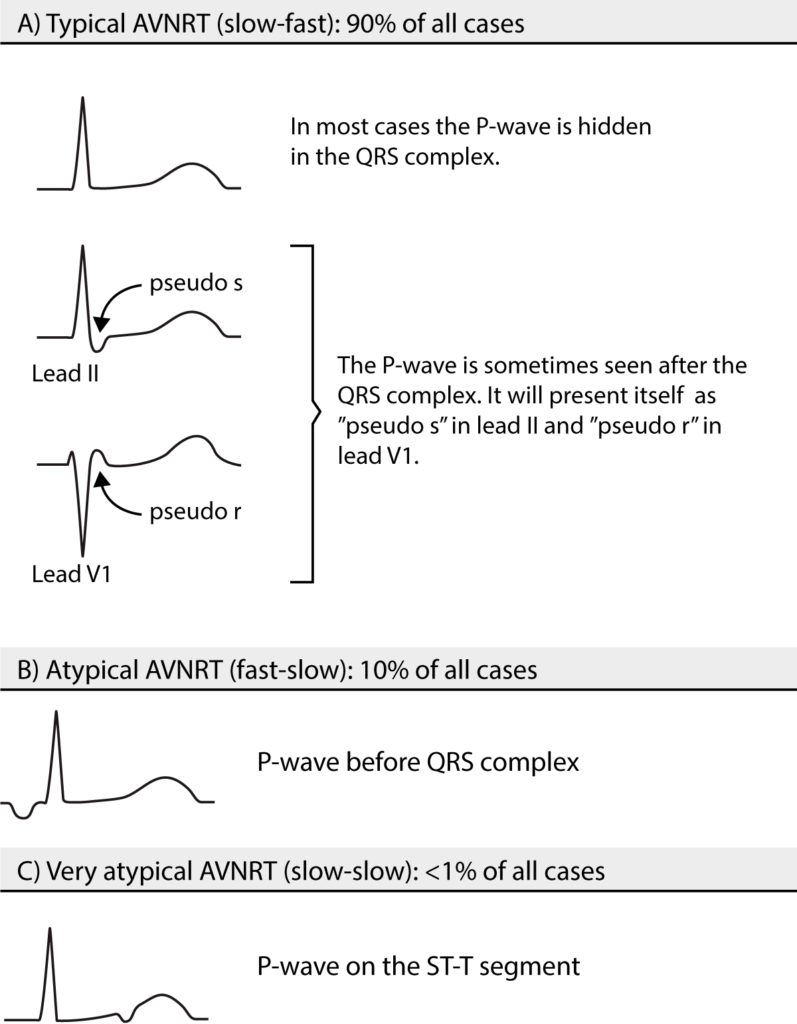 Figure 2. Types of atrioventricular nodal reentry tachycardia (AVNRT).