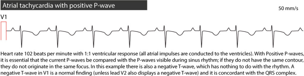 Figure 3. Atrial tachycardia.