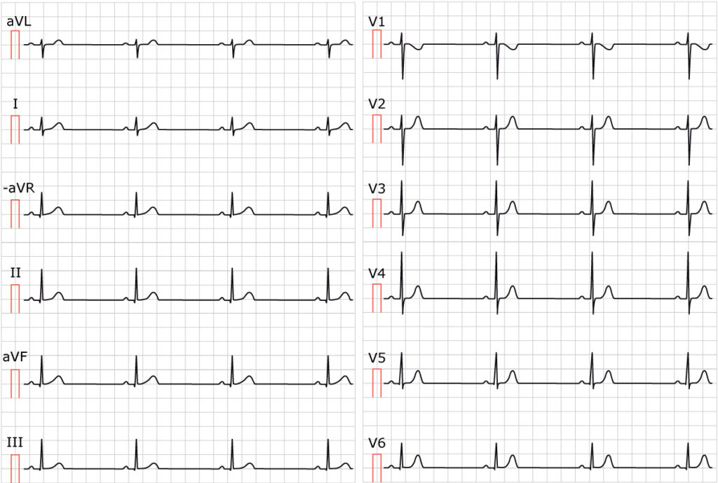 Figure 1. Sinus bradycardia. Paper speed 25 mm/s. Calculate the rate by dividing 300 by the number of large boxes between two cycles (e.g between two R waves). As seen in the figure, there are approximately 6.5 large boxes between two R waves. 300/6.5 equals 46 beats/min.