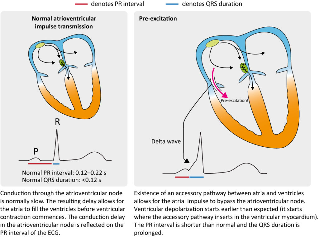 Figure 1. Hallmarks of pre-excitation on the ECG.
