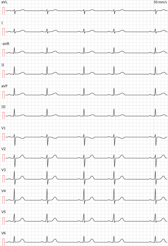 Figure 1. Sinus arrhythmia (respiratory sinus arrhythmia).