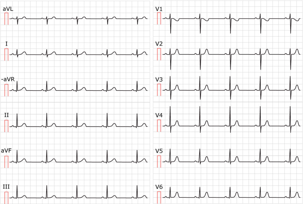 Figure 1. Sinus rhythm. Paper speed 25 mm/s.