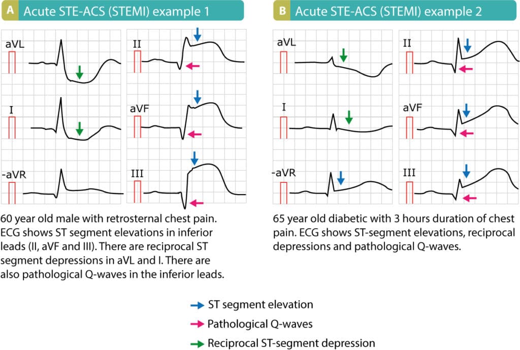 ECGs showing acute STEMI in two patients with severe chest pain. STEMI = ST elevation Myocardial Infarction.
