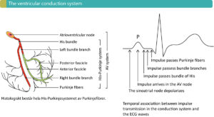 Figure 1. Components of the ventricular conduction system and the temporal association between the ECG waveforms and impulse transmission through the heart. Atrioventricular (AV) blocks occur due to dysfunction in the conduction system.