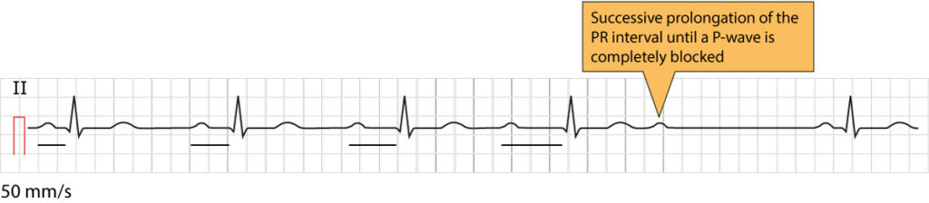 Figure 1. Second-degree AV block Mobitz type 1, also known as Wenckebach block.
