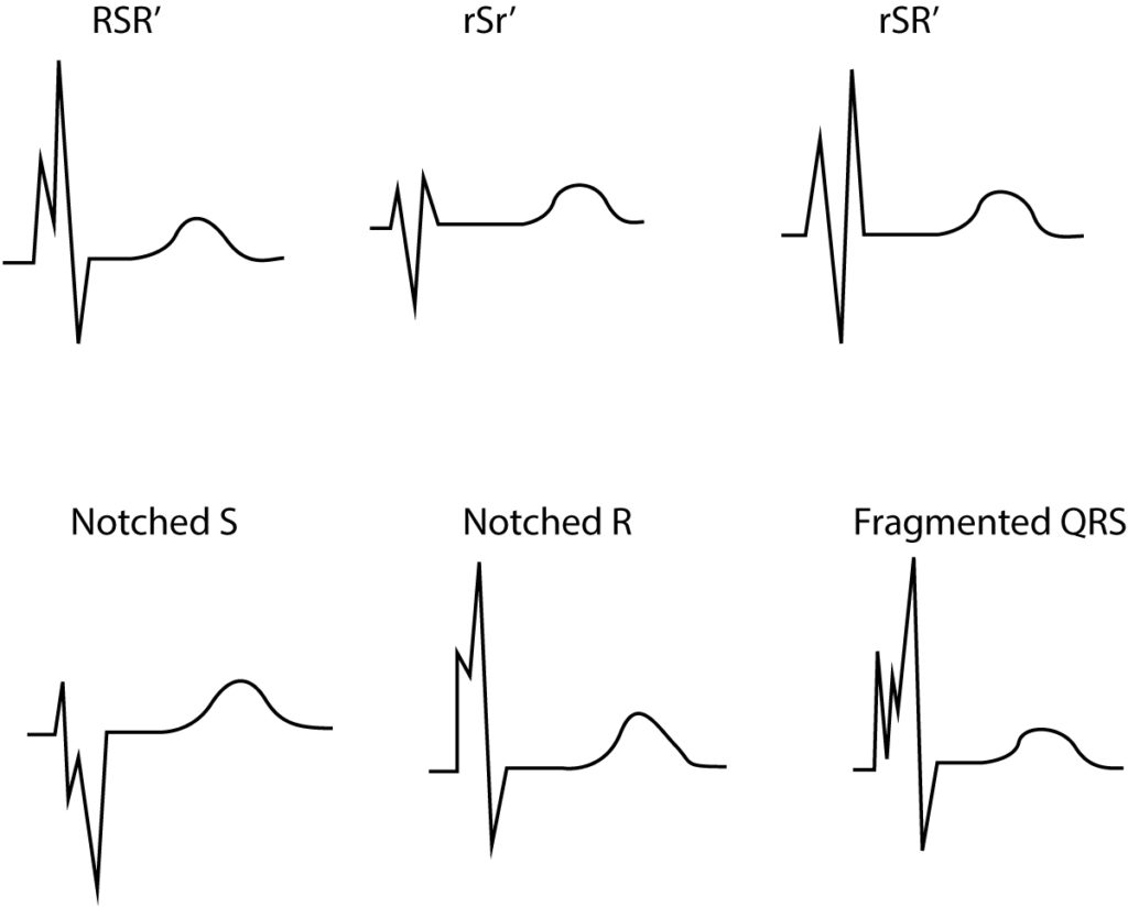 sonstige-ekg-ver-nderungen-bei-isch-mie-und-infarkt-ekg-echo