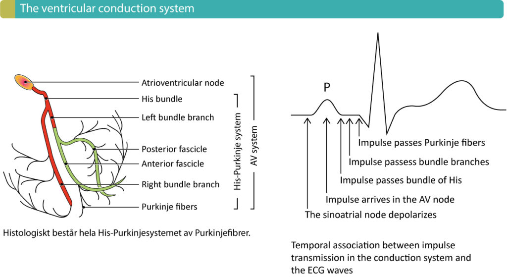 Figure 1. Components of the ventricular conduction system and the temporal association between the ECG and impulse transmission through the heart. An intranventricular conduction delay may occur whenever any of the main components of the conduction system is dysfunctional.