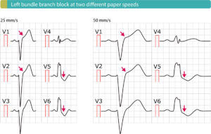 Figure 4. Left bundle branch block (LBBB) with typical ST elevations (V1–V2) and ST depressions (V5-V6).