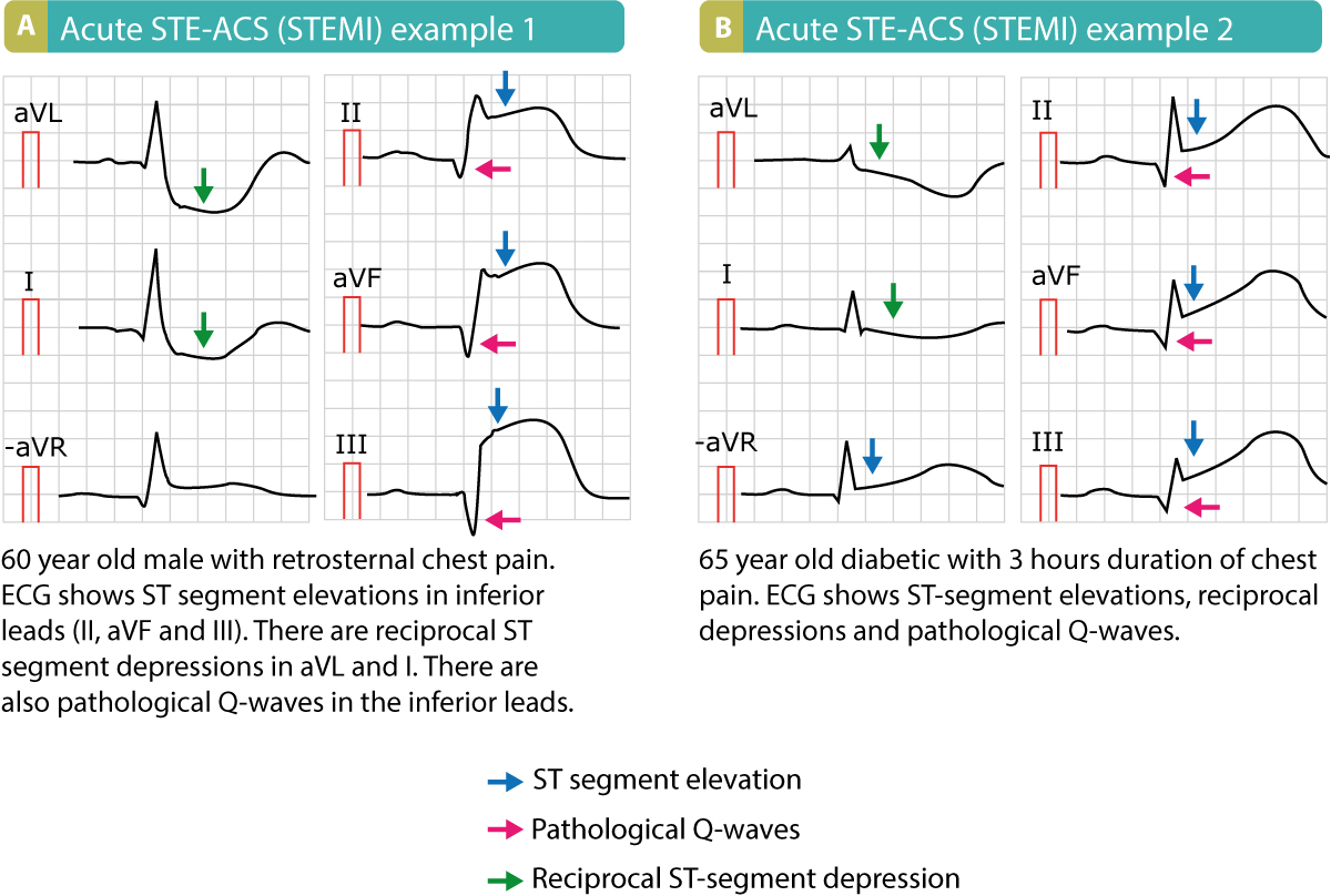 ekg-zeichen-eines-myokardinfarkt-pathologische-q-zacken