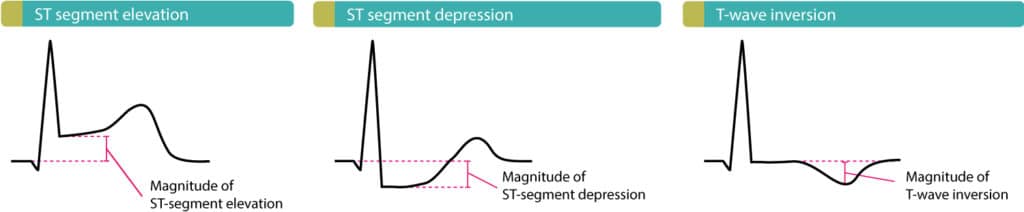 Figure 2. This figure illustrates ST elevations, ST depressions and T-wave inversions. Patients with STEMI (STE-ACS) always display ST elevations but they may also display ST depressions and/or T-wave inversions. Patients with NSTE-ACS (NSTEMI, unstable angina), on the other hand, may only display ST depressions and/or T-wave inversions.