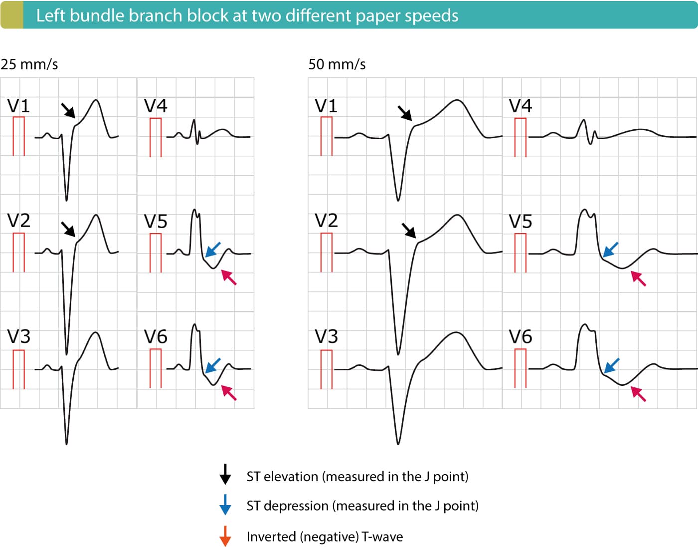 Recognizing Left Bundle Branch Block And When It Matters FYRI Recognizing Left Bundle Branch Block And When It Matters FYRI
