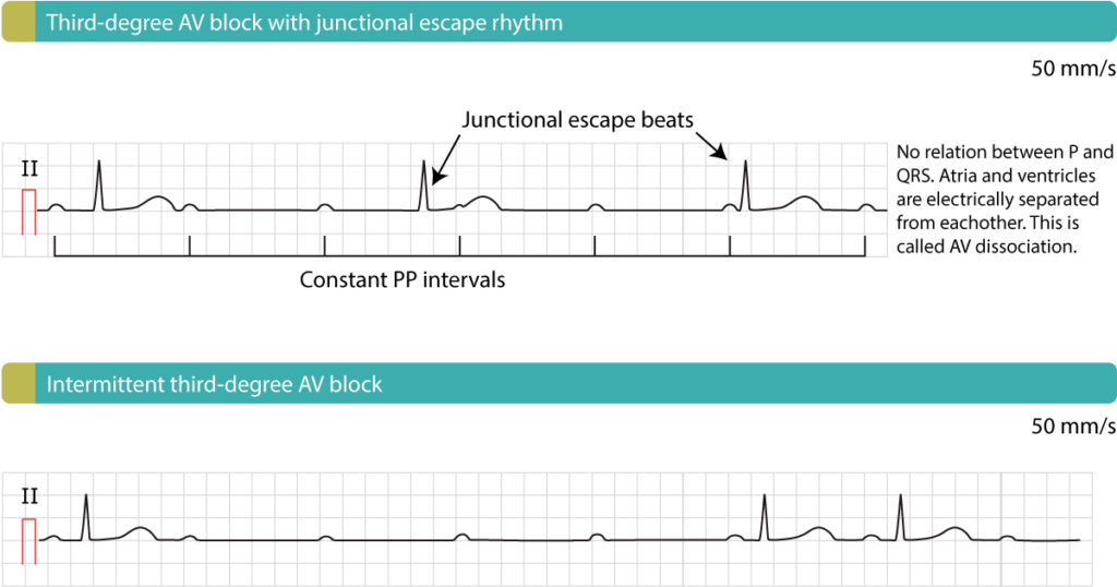 Management of AV blocks (treatment)