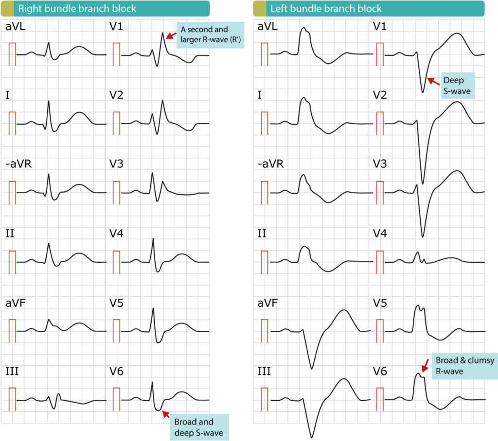 Figure 2. Right bundle branch block (RBBB) and left bundle branch block (LBBB). Note that the paper speed is 50 mm/s (1 large box equals 100 ms). The hallmark of both RBBB and LBBB is the QRS duration which is by definitions 120 ms or longer. The distinction between RBBB and LBBB is simple, as illustrated in this figure.