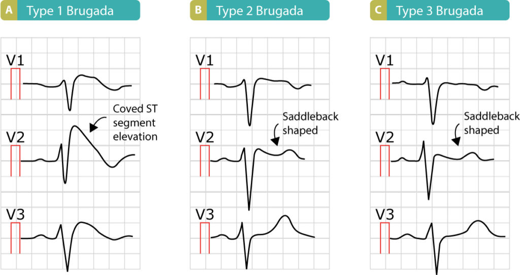 Figure 10. ECGs presenting Brugada syndrome type 1, type 2 and type 3, respectively.