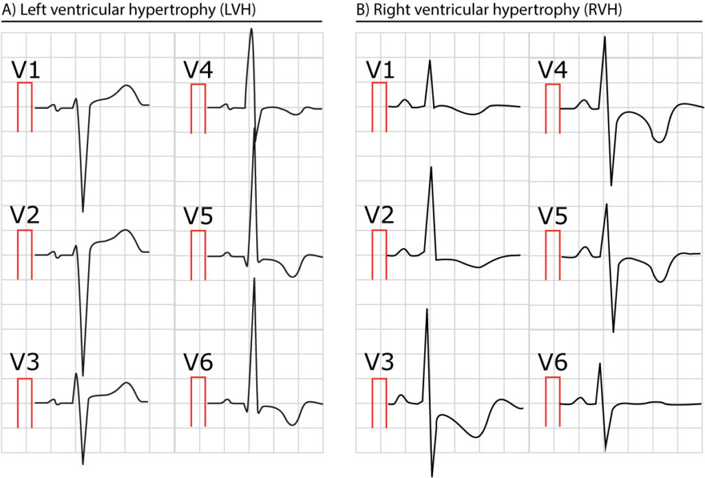Figure 2. Two ECGs showing left and right ventricular hypertrophy.