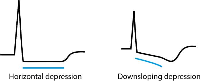 Figure 1. Characteristics of ischemic ST segment depressions on ECG.