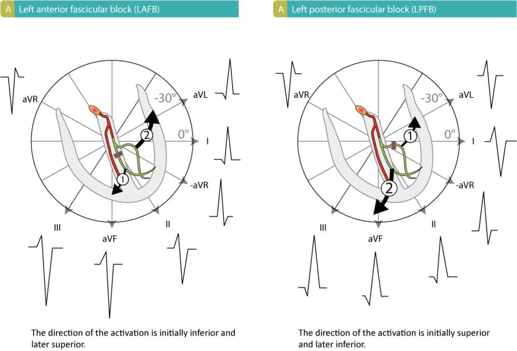 Figure 1. Left anterior fascicular block (hemiblock) and left posterior fascicular block (hemiblock). Inspired by GS Wagner (Marriott's Practical Electrocardiography, Elsevier 2007) and AL Goldberg (Clinical Electrocardiography: A Simplified Approach, Elsevier Mosby 2006).