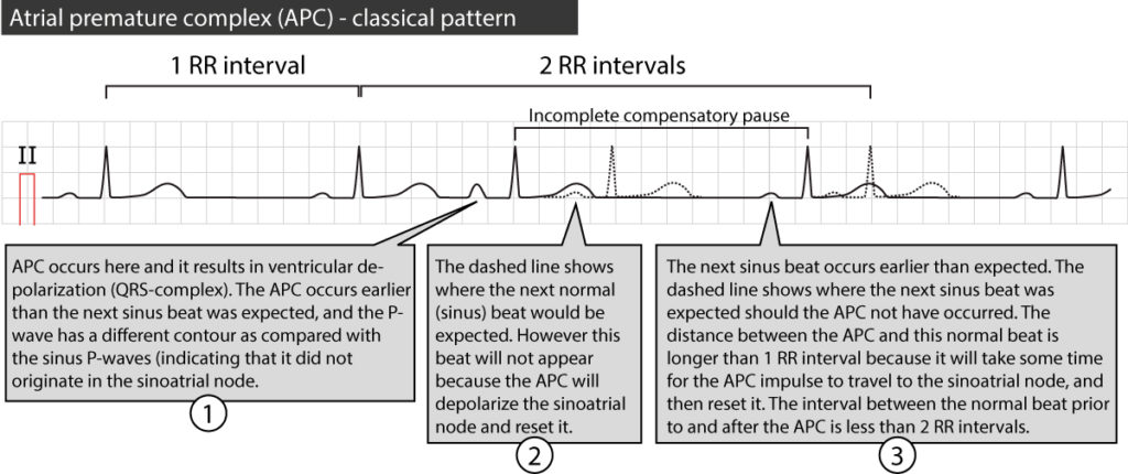 Figure 4. Premature atrial beat with incomplete compensatory pause.