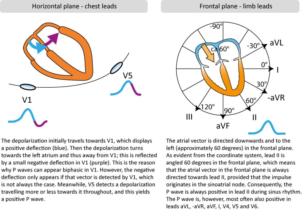 Figure 2. P-wave morphology in chest and limb leads.