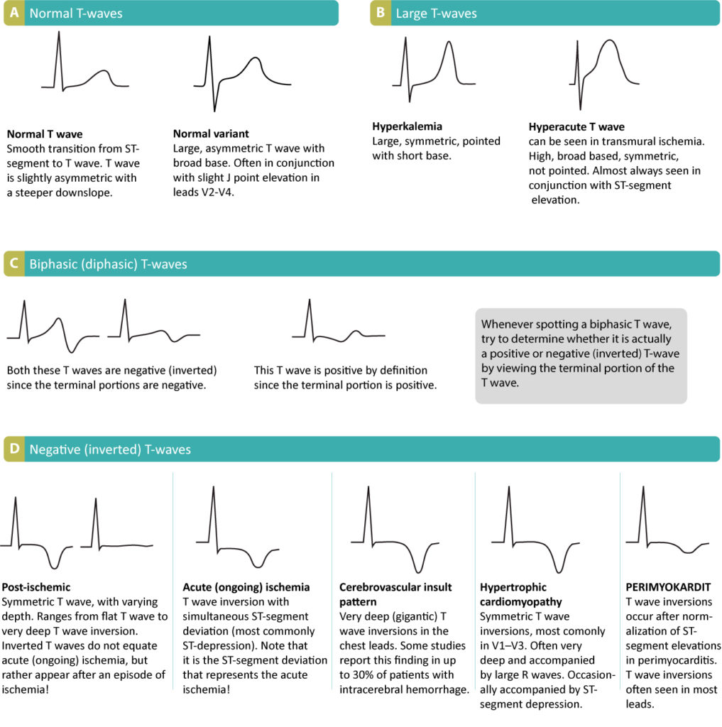 Figure 1. Various T-wave abnormalities, including T-wave changes related to myocardial ischemia.