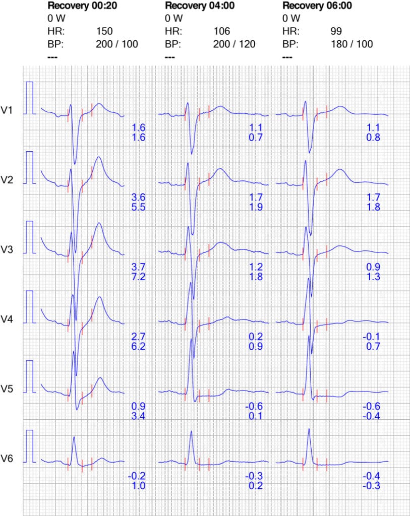 Figure 10. ECG reaction in chest leads during recovery.