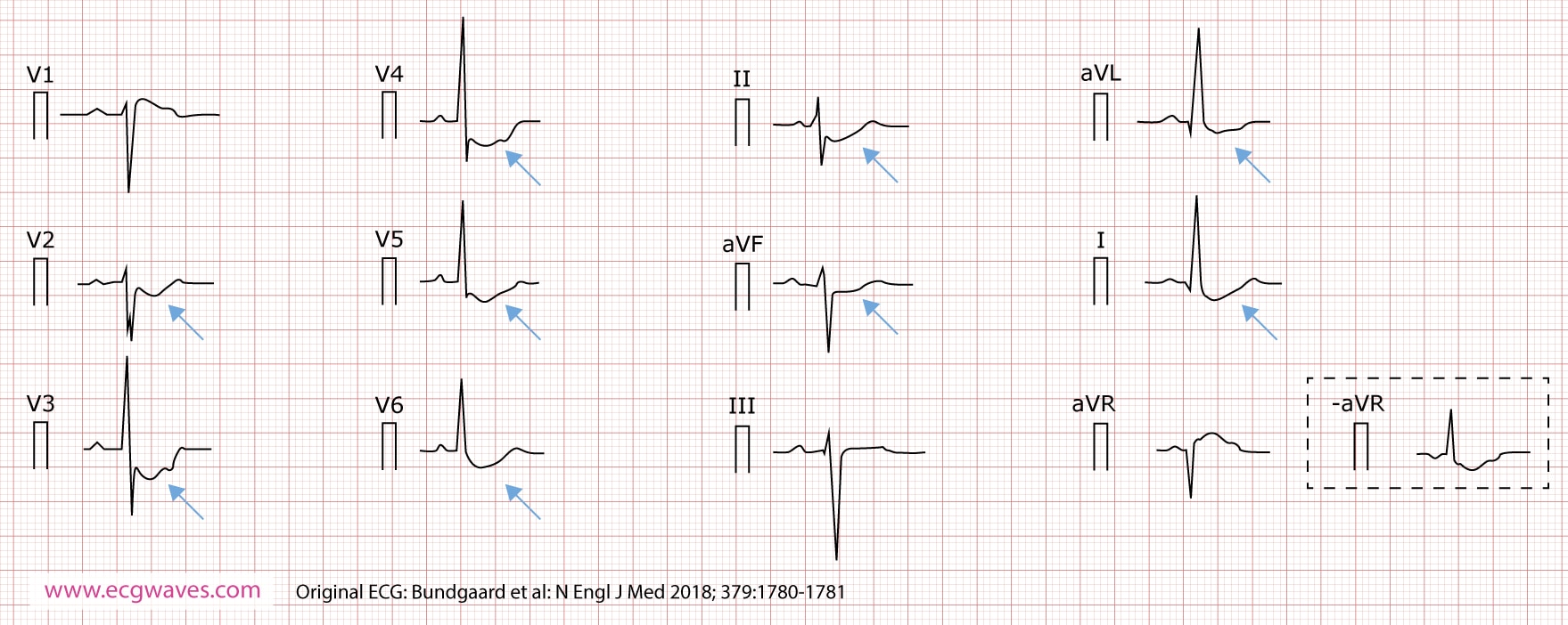 12-lead ECG (presented according to Cabrera), recorded at 63 years of age, demonstrates concave-upward ST-segment depression in leads I, II, aVL, aVF, and V2 through V6; and ST-segment elevation in lead aVR (which corresponds to an identical ST-segment depression in the inverted lead -aVR). A notch is evident in the ascending part of the ST segment.