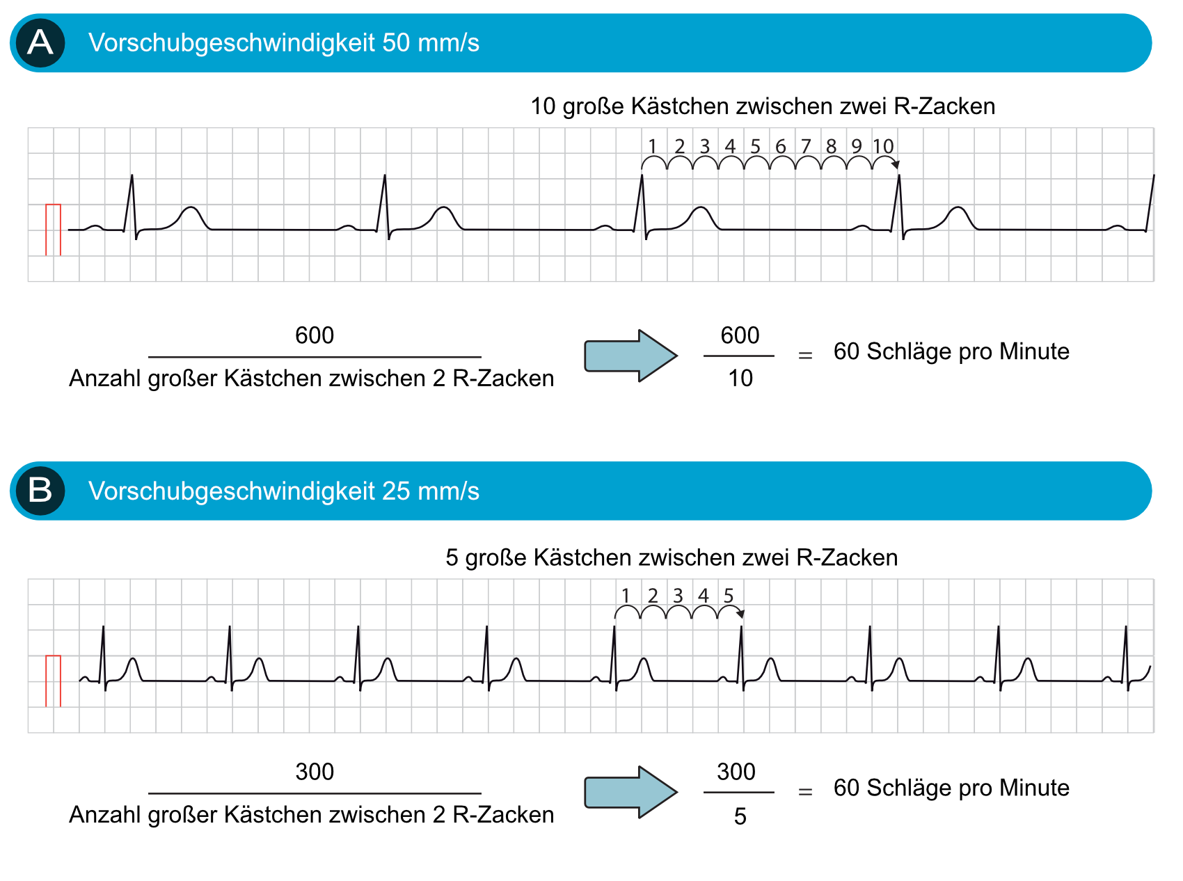 Der Sinusrhythmus: Physiologie, EKG-Kriterien und klinische Bedeutung ...