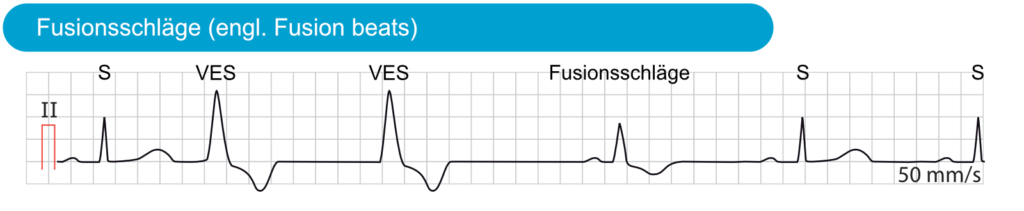 Ventrikuläre Extrasystolen (VES) – EKG & ECHO