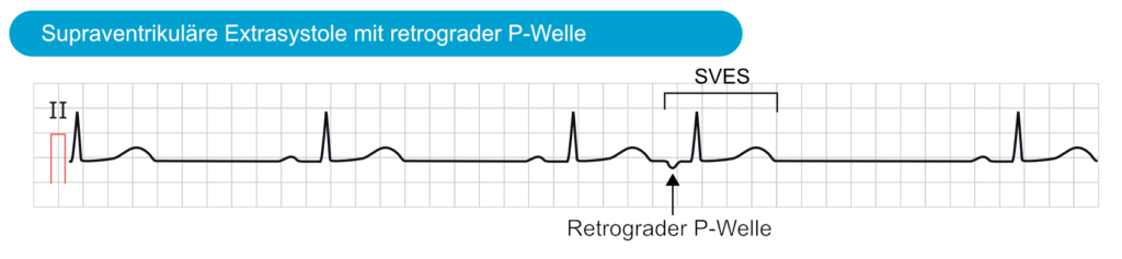 Supraventrikuläre Extrasystolen (SVES): EKG & klinische Bedeutung – EKG