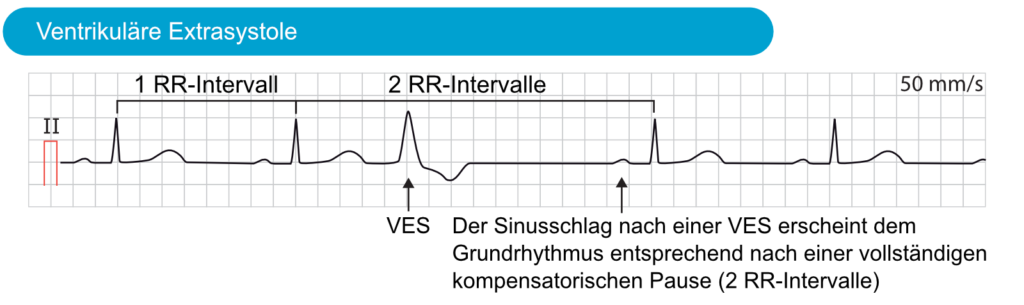 Ventrikuläre Extrasystolen (VES) – EKG & ECHO