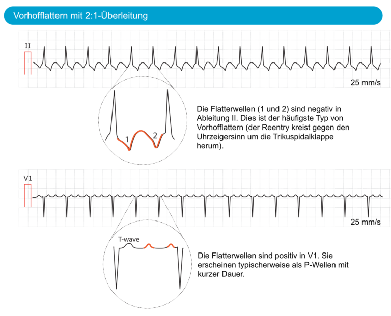 Vorhofflattern Einstufung, Ursachen, EKGKriterien und Management