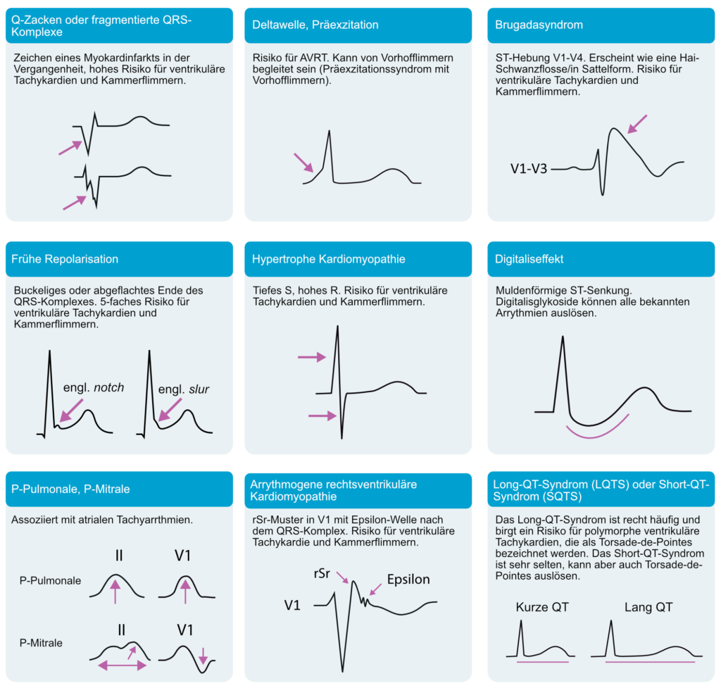 Diagnose und Management von Tachyarrhythmien: Breitkomplextachykardien und ...