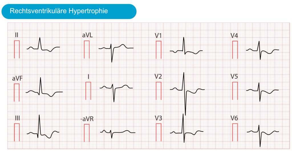 STHebungsinfarkt (STEMI) ohne STHebungen im 12KanalEKG • EKG & ECHO