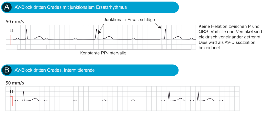 Av Block 3 Grades Therapie