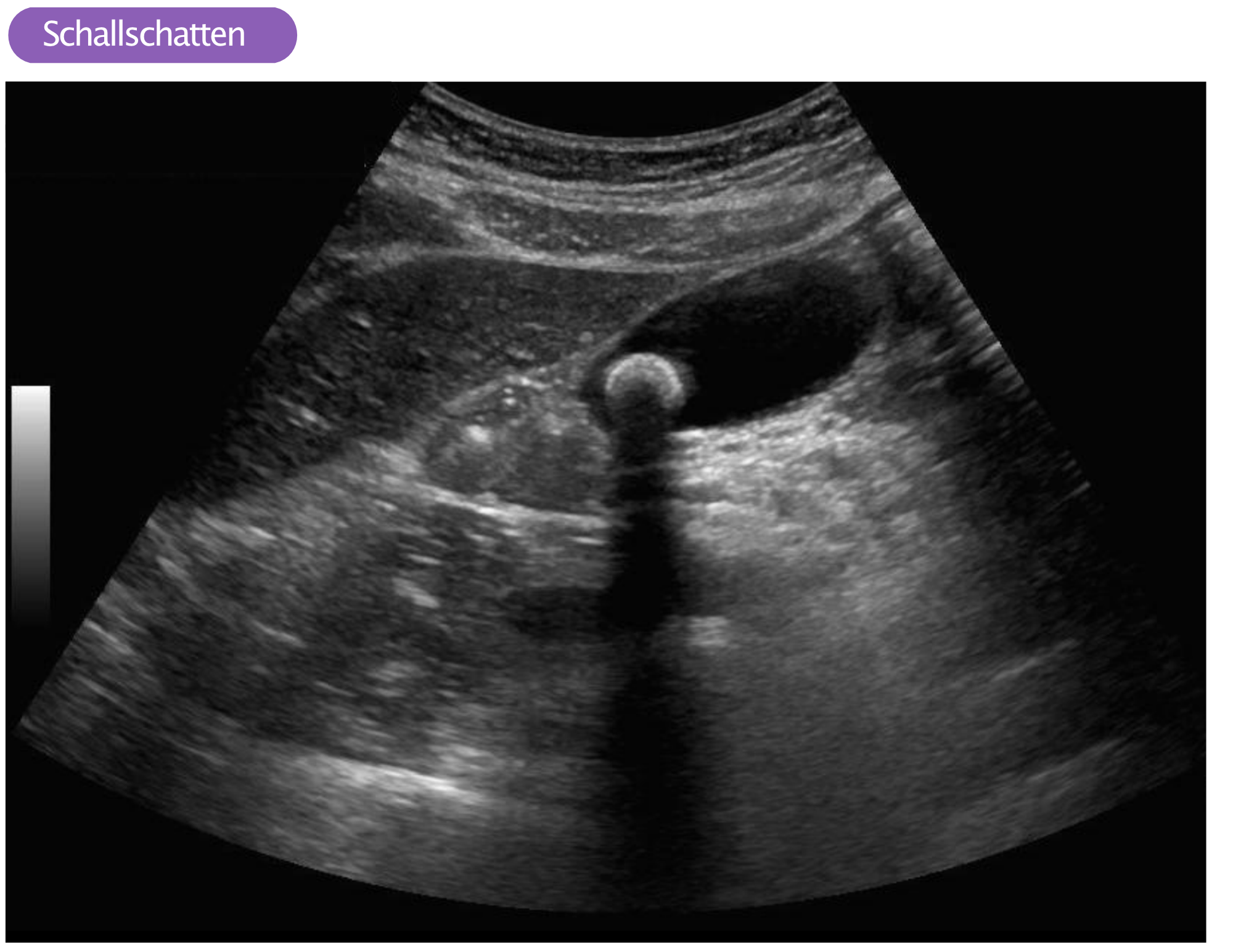 Artefakte in der Ultraschallbildgebung EKG & ECHO