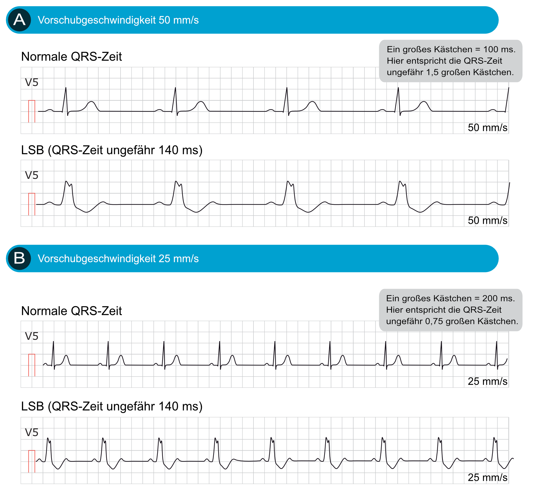 Linksschenkelblock (LSB): EKG-Kriterien, Ursachen, Management