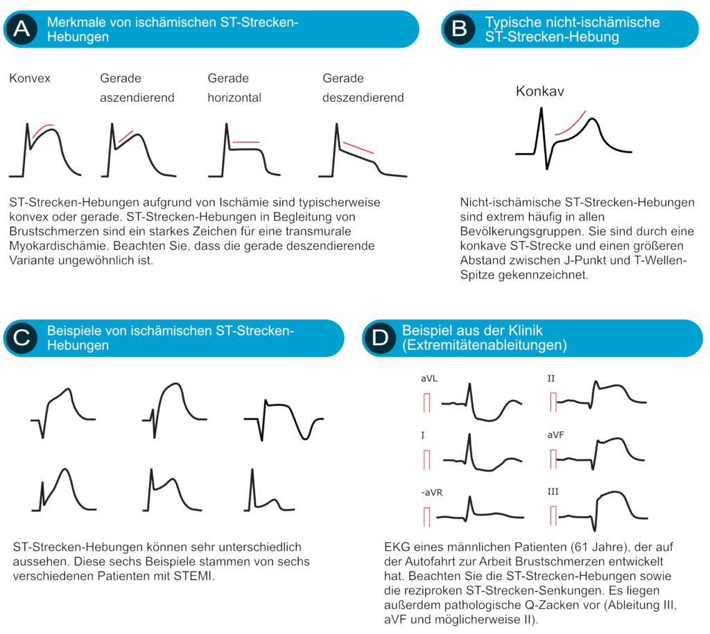 ST-Hebung bei akuter Myokardischämie und Differentialdiagnosen – EKG & ECHO