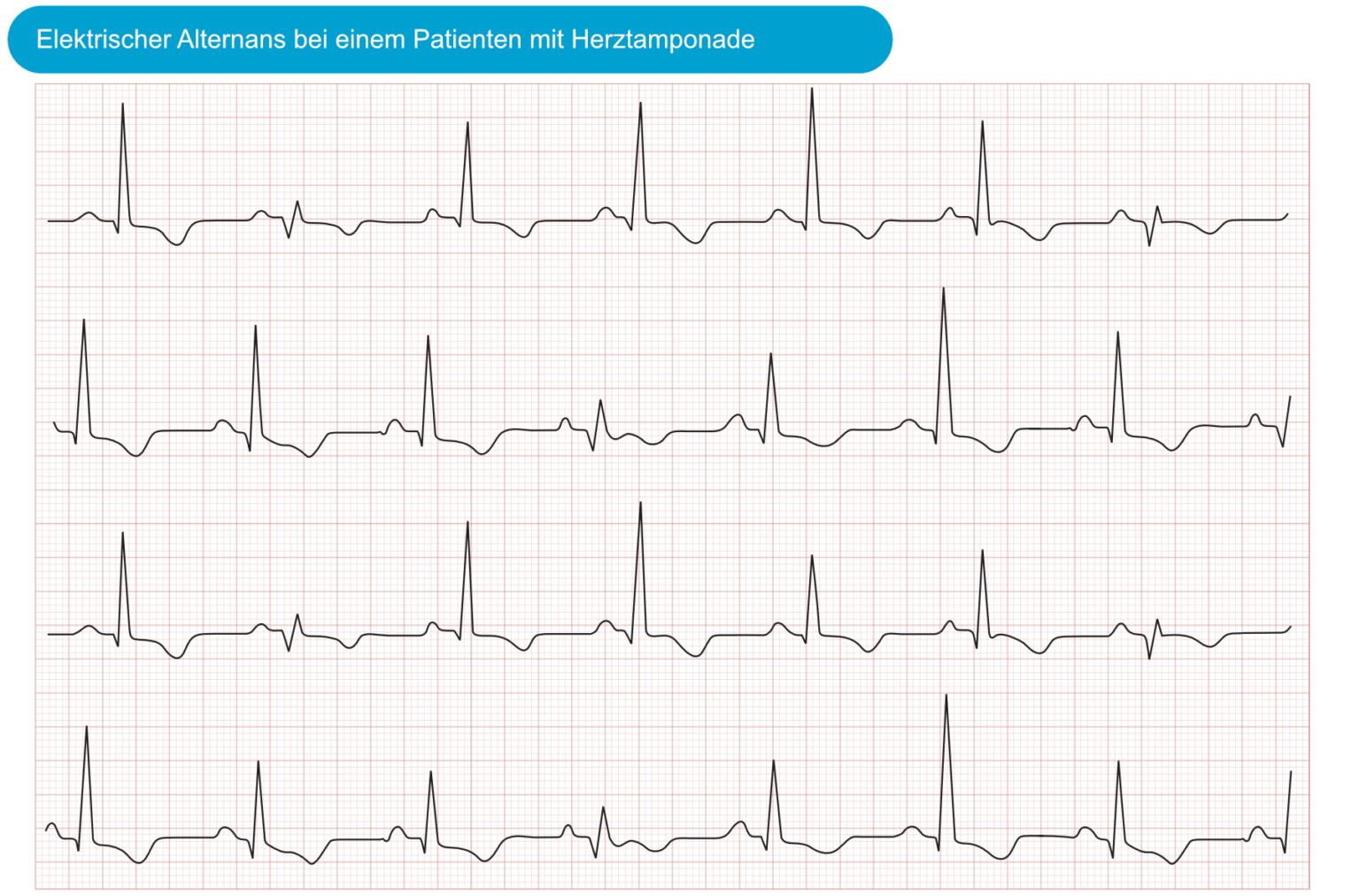 Elektrischer Alternans EKG & ECHO