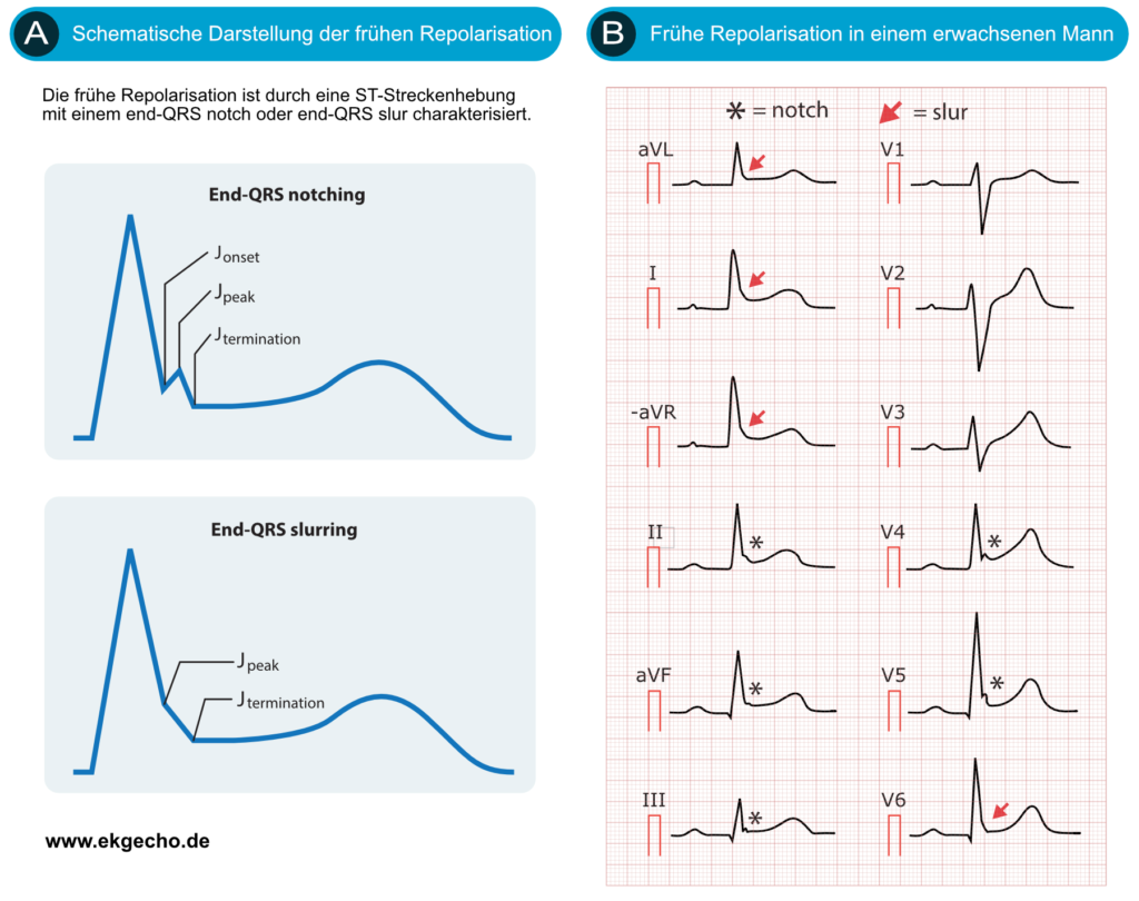 Abbildung 5. Frühe Repolarisation (nach MacFarlane et al., 2016, Eur Hear J).