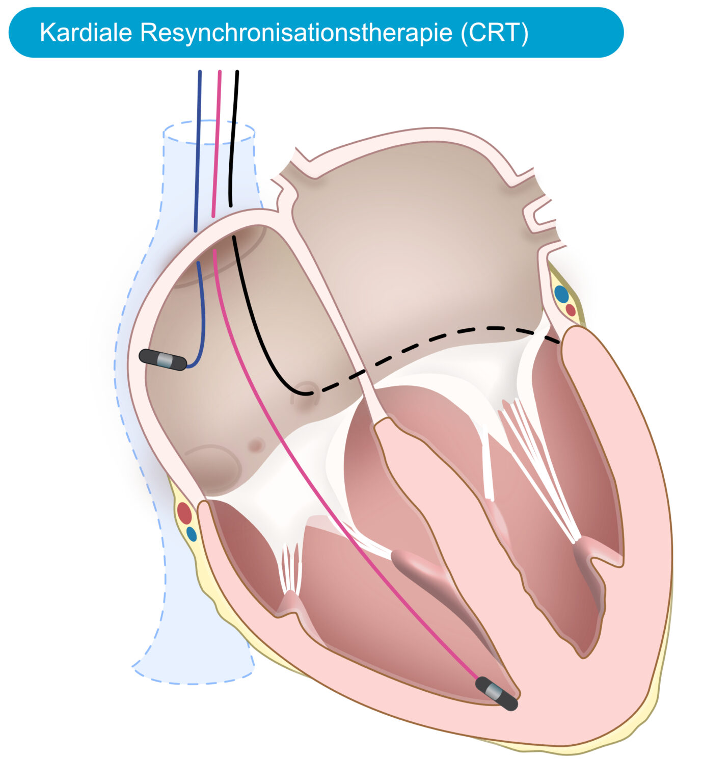 Grundlegende Funktionsweise, Funktionen und Einstellungen eines Herzschrittmachers – EKG & ECHO