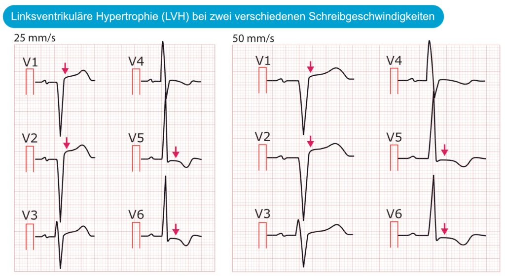 Abbildung 6. Die linksventrikuläre Hypertrophie verursacht sekundäre ST-T-Veränderungen, einschließlich ST-Streckenhebungen.