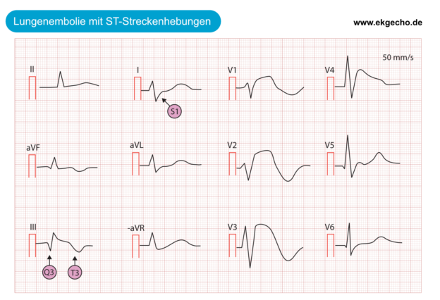 Hebung In Der Verslehre ST-Hebung bei akuter Myokardischämie und Differentialdiagnosen – EKG & ECHO
