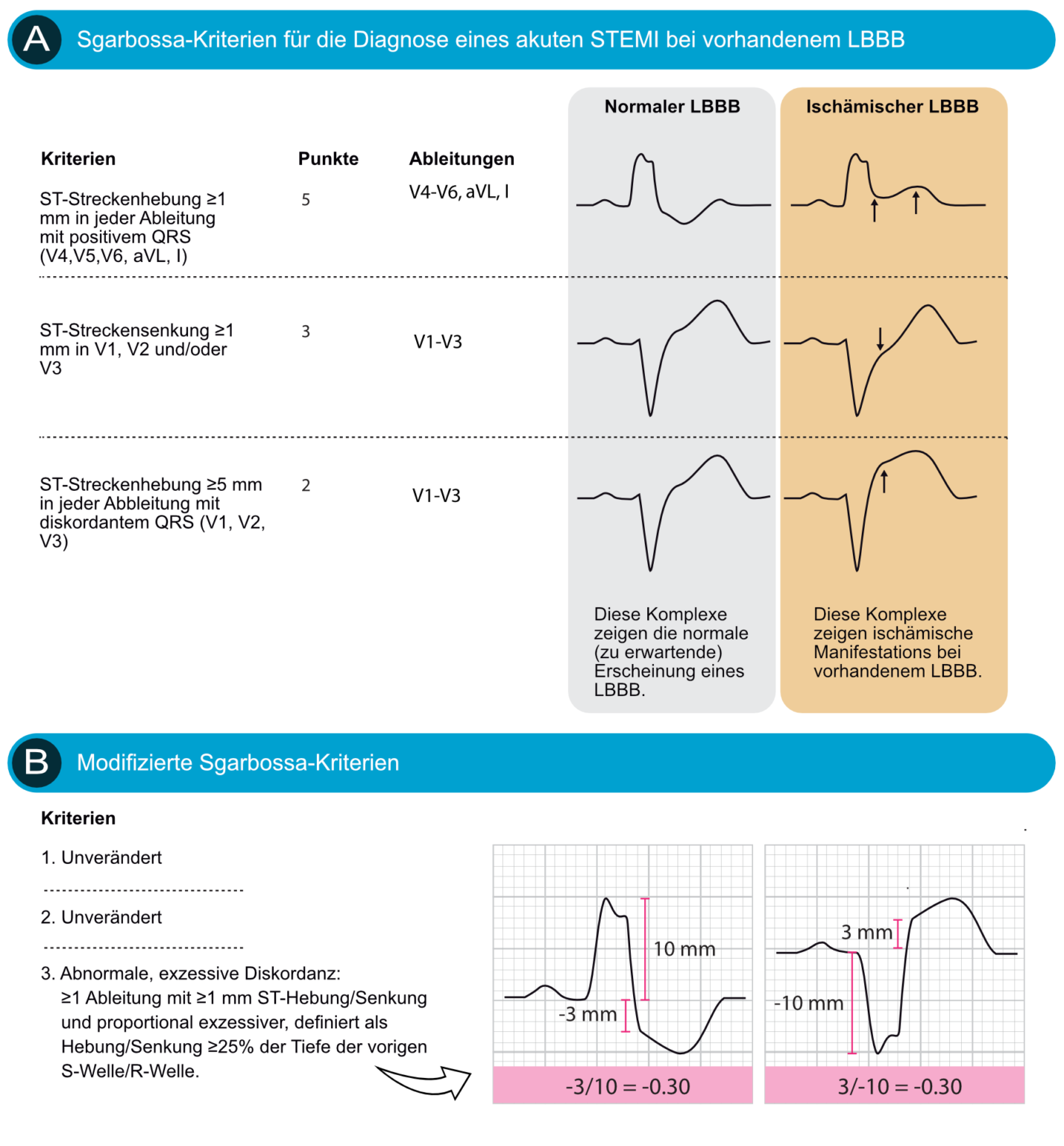 Linksschenkelblock (LSB) bei akutem Myokardinfarkt: Die Sgarbossa ...