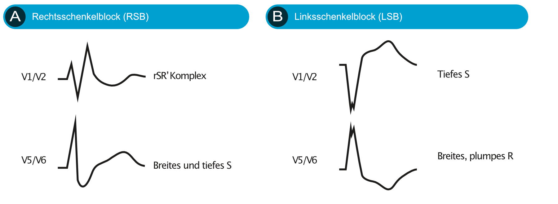 Intraventrikuläre Leitungsverzögerung Schenkelblöcke & Faszikelblöcke