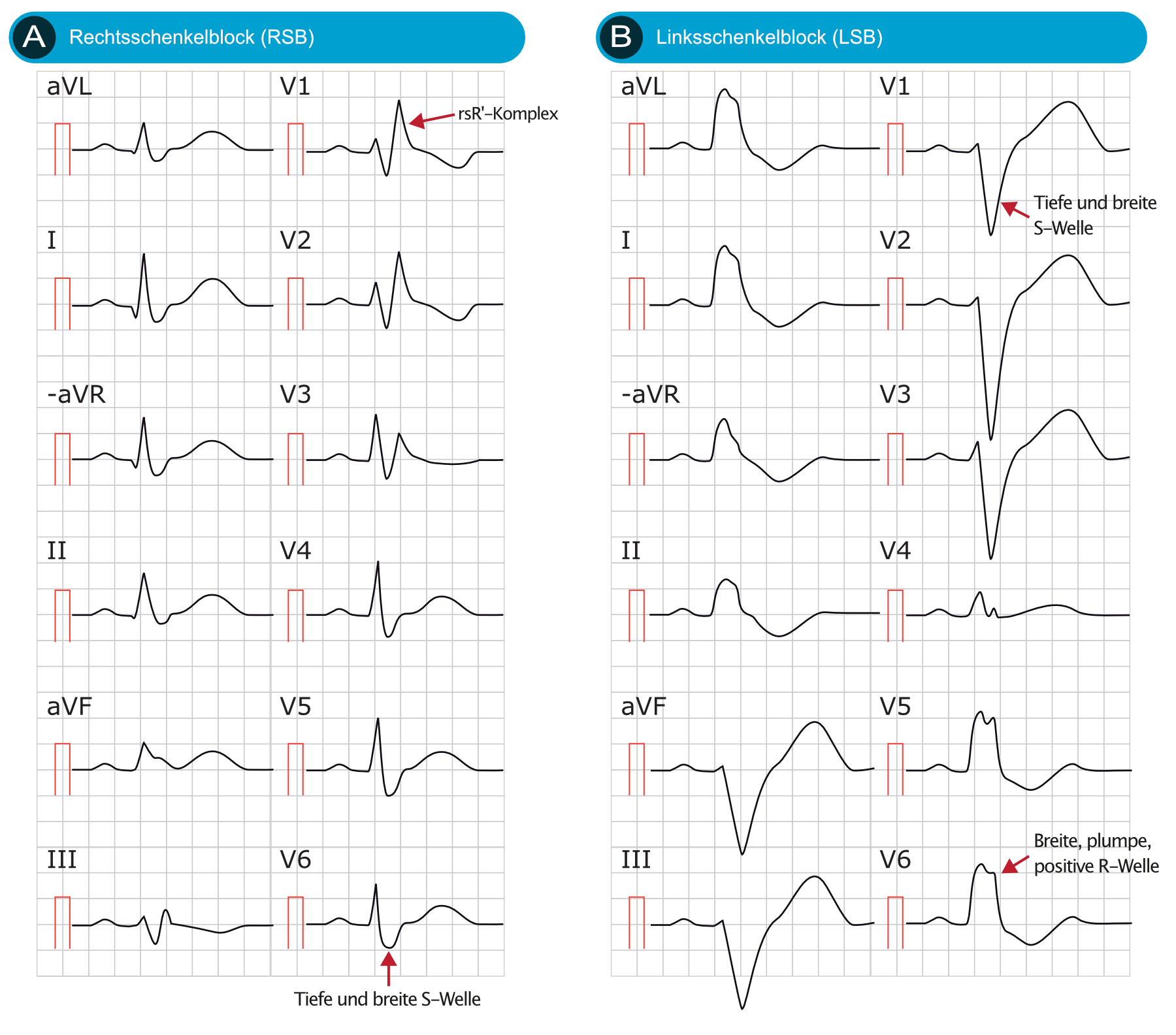 Rechtsschenkelblock (RSB): EKG, Kriterien, Definitionen, Ursachen ...